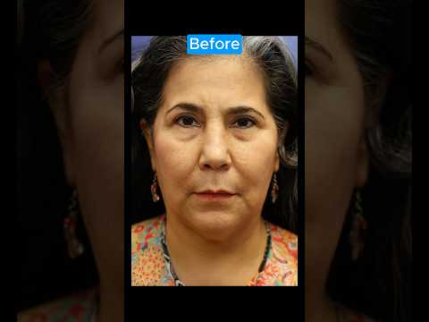 EPIC FACELIFT TRANSFORMATION