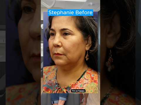 My PERFECT Facelift 2 Year Update (Interview)