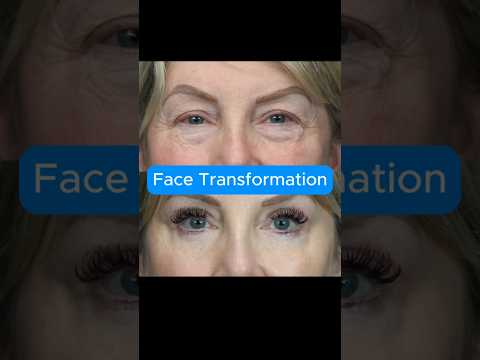 FILLER CAN'T DO THIS TRANSFORMATION!! (BEFORE AFTER) #blepharoplasty