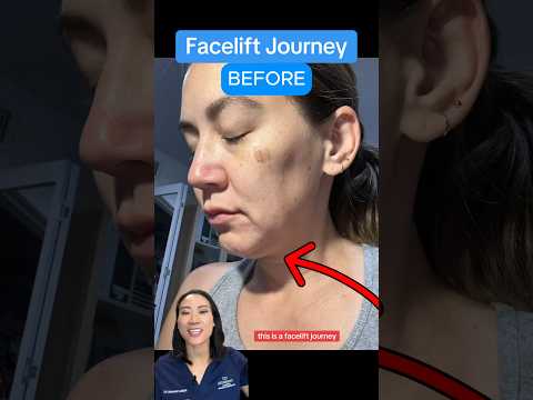 This Is A Facelift Journey (BEFORE AFTER RESULTS)