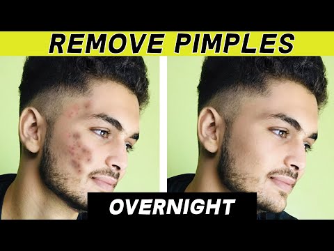 How To Remove Pimples Overnight (Naturally) || 3 Easiest Remedies To Get Clearer Skin With No Scars