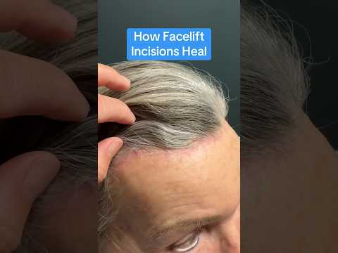 How Facelift Incisions Heal (Surgeon Reacts) #facelift