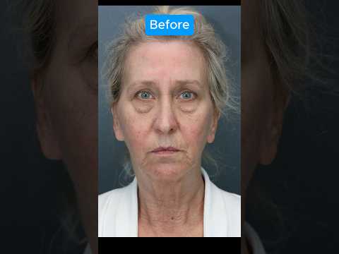 DRAMATIC TRANSFORMATION #blepharoplasty