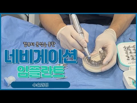 네이게이션임플란트 수술과정