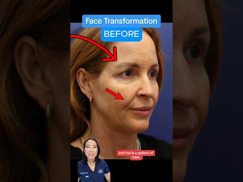 FULL Facelift Transformation!! (BEFORE AFTER)